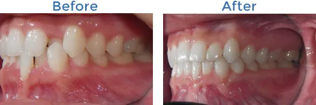 before-after-ortho2