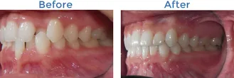 before-after-ortho2
